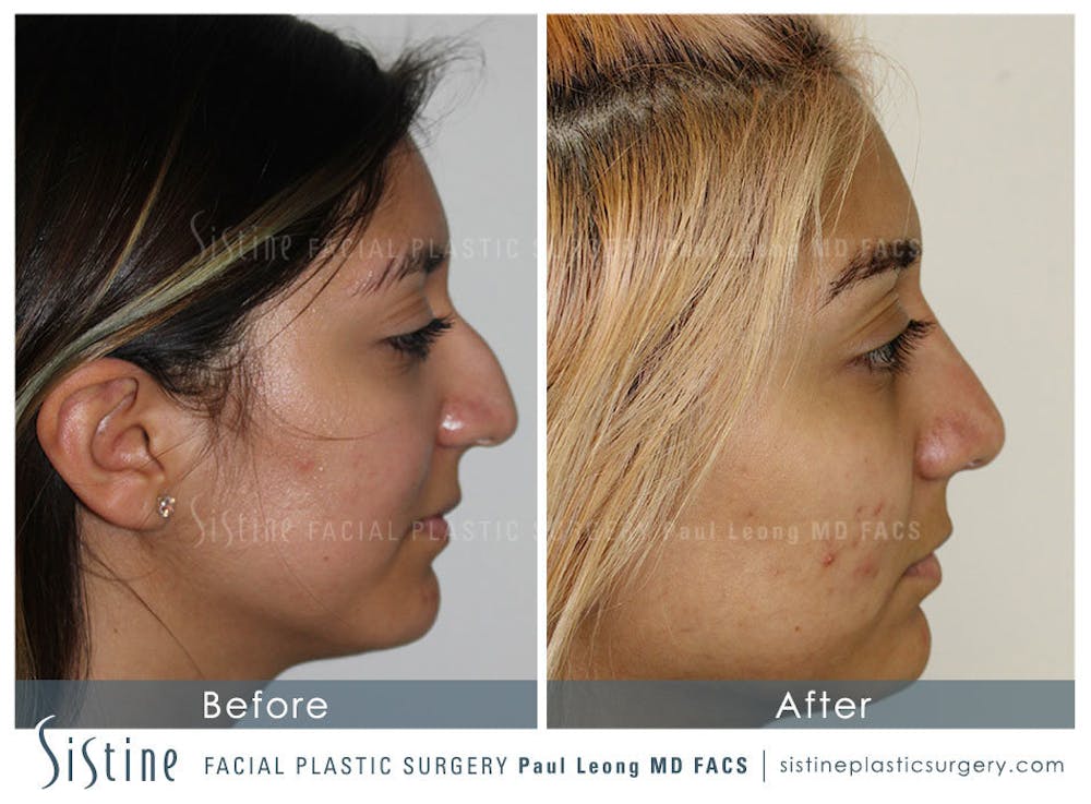 Nose Before & After Gallery - Patient 4890128 - Image 2