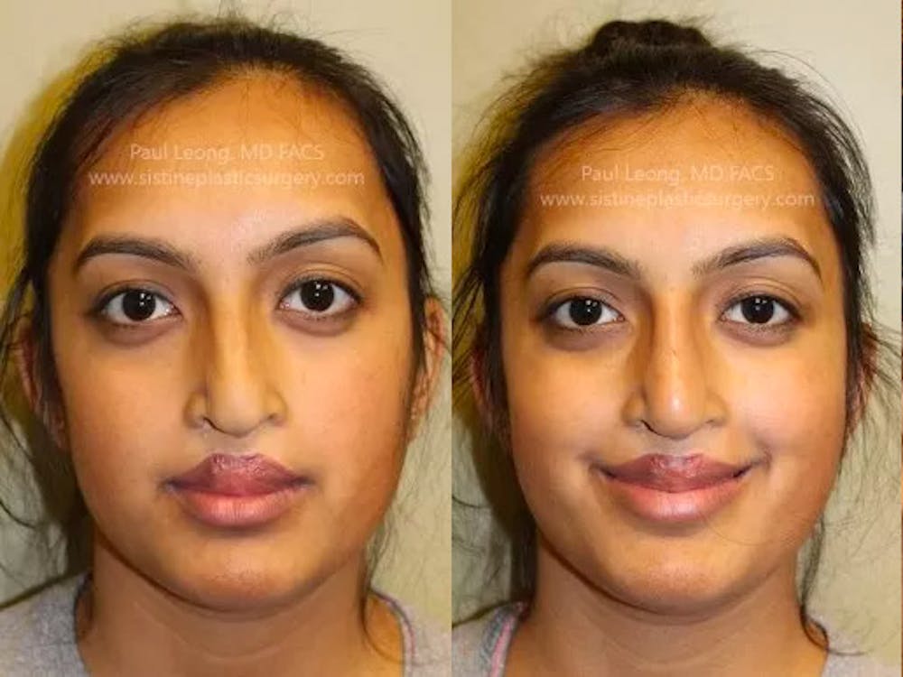 Dermal Fillers Before & After Gallery - Patient 4890582 - Image 3
