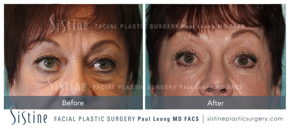 Dermal Fillers Before & After Gallery - Patient 4890617 - Image 1