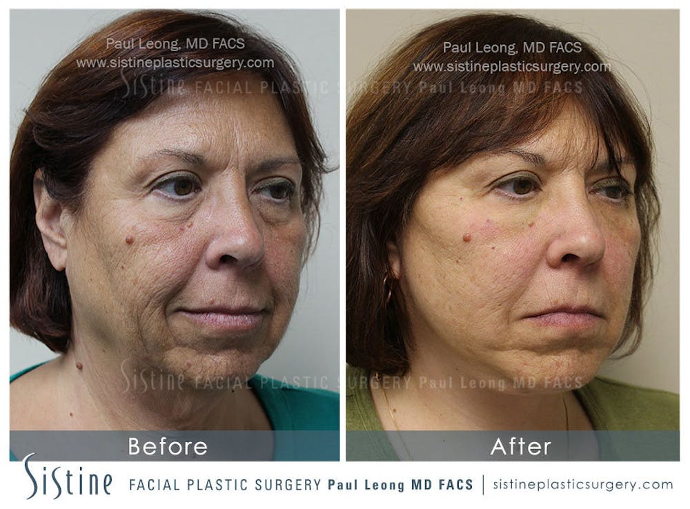 Dermal Fillers Before & After Gallery - Patient 4890892 - Image 3
