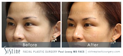 Dermal Fillers Before & After Gallery - Patient 4890895 - Image 2