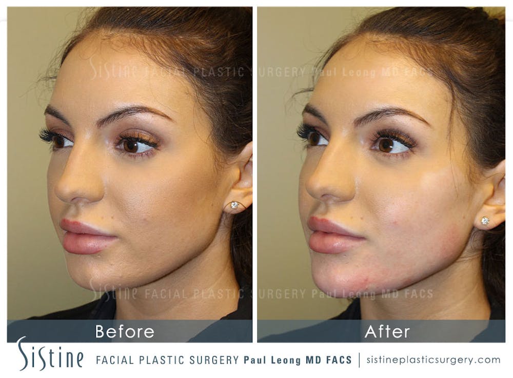 Dermal Fillers Before & After Gallery - Patient 4890902 - Image 1