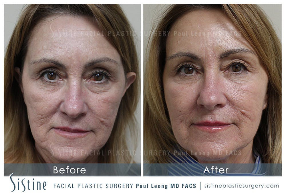 Sculptra® Before & After Gallery - Patient 4890974 - Image 1