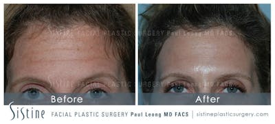Botox® Cosmetic/ Dysport Before & After Gallery - Patient 4890982 - Image 1