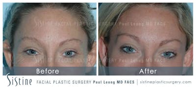 Botox® Cosmetic/ Dysport Before & After Gallery - Patient 4890984 - Image 1