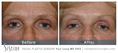Botox® Cosmetic/ Dysport Before & After Gallery - Patient 4890985 - Image 1