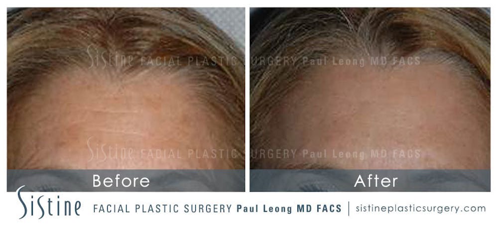 Botox® Cosmetic/ Dysport Before & After Gallery - Patient 4890986 - Image 1