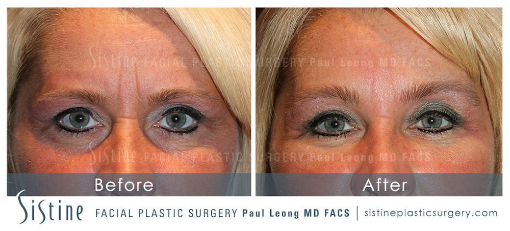 Botox® Cosmetic/ Dysport Before & After Gallery - Patient 4890988 - Image 1