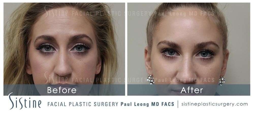 Botox® Cosmetic/ Dysport Before & After Gallery - Patient 4890989 - Image 1