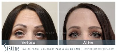Botox® Cosmetic/ Dysport Before & After Gallery - Patient 4890991 - Image 1