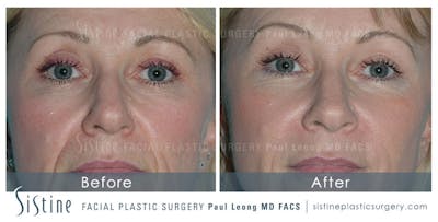 Botox® Cosmetic/ Dysport Before & After Gallery - Patient 4890993 - Image 1