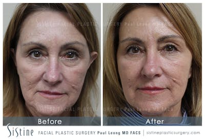 Botox® Cosmetic/ Dysport Before & After Gallery - Patient 4890994 - Image 1