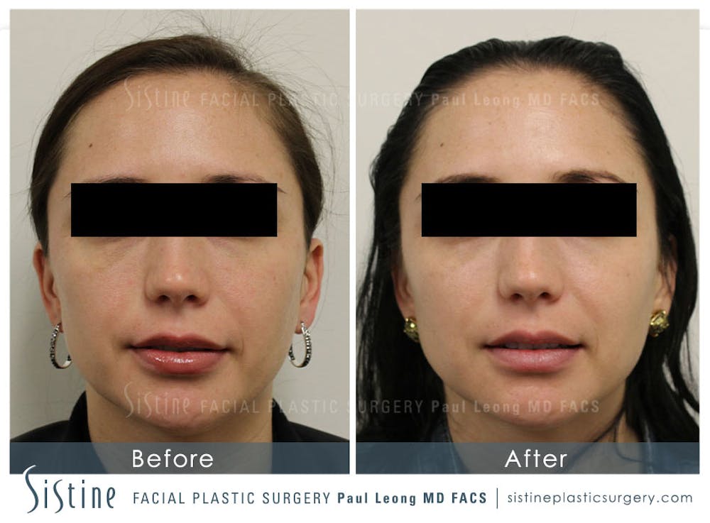 Botox® Cosmetic/ Dysport Before & After Gallery - Patient 4890997 - Image 2