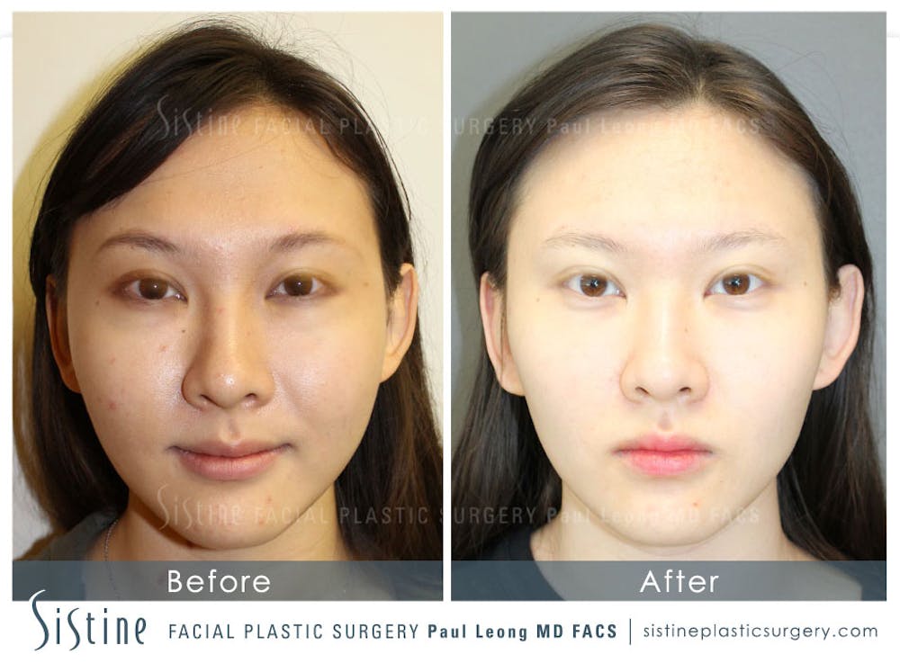 Asian Non Surgical Innovations Gallery - Patient 4891012 - Image 1