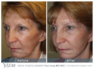 Jawline Slimming Before & After Gallery - Patient 4891017 - Image 1