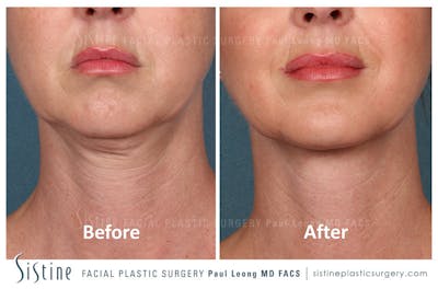 Kybella Before & After Gallery - Patient 4891020 - Image 1