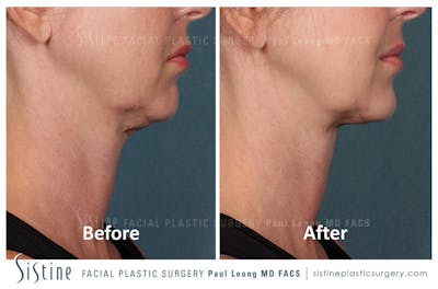Kybella Before & After Gallery - Patient 4891021 - Image 1