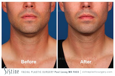 Kybella Before & After Gallery - Patient 4891023 - Image 1