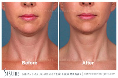 Kybella Before & After Gallery - Patient 4891026 - Image 1