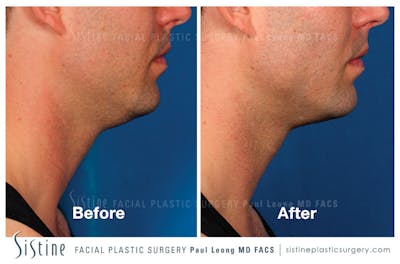 Kybella Before & After Gallery - Patient 4891028 - Image 1