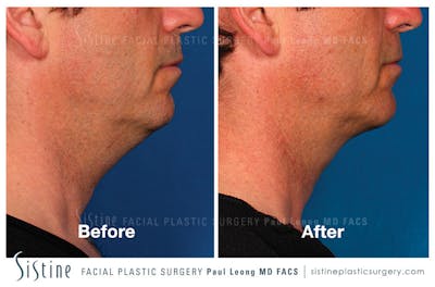 Kybella Before & After Gallery - Patient 4891029 - Image 1