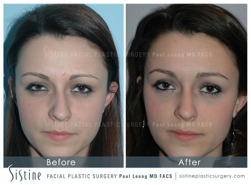 Non-Surgical Rhinoplasty Before & After Gallery - Patient 4891033 - Image 1