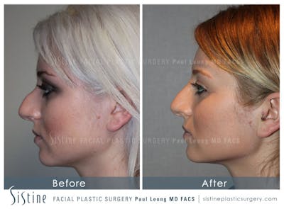 Non-Surgical Rhinoplasty Before & After Gallery - Patient 4891037 - Image 1