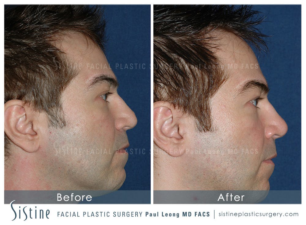 Non-Surgical Rhinoplasty Before & After Gallery - Patient 4891040 - Image 1