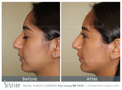 Non-Surgical Rhinoplasty Before & After Gallery - Patient 4891043 - Image 1