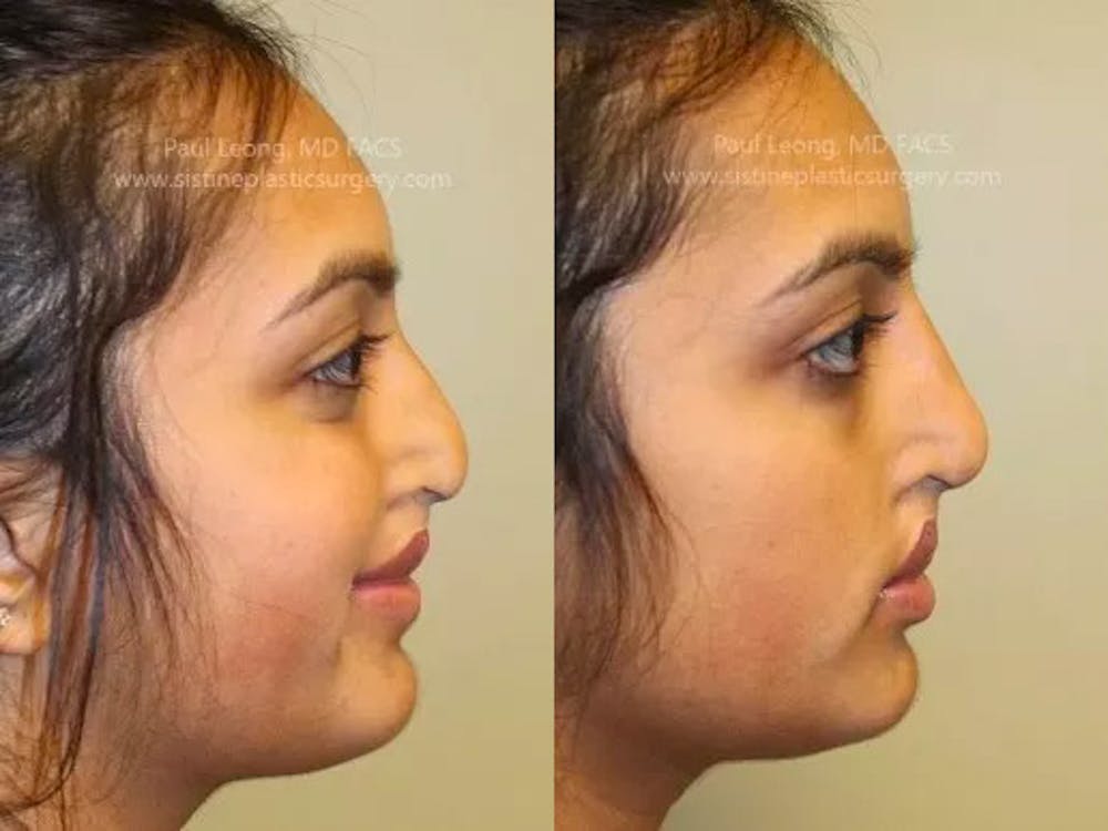 Non-Surgical Rhinoplasty Before & After Gallery - Patient 4891048 - Image 1
