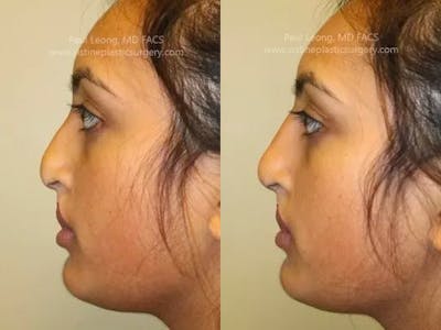 Non-Surgical Rhinoplasty Gallery - Patient 4891048 - Image 2