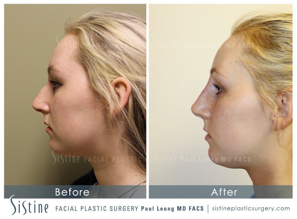 Non-Surgical Rhinoplasty Before & After Gallery - Patient 4891053 - Image 1