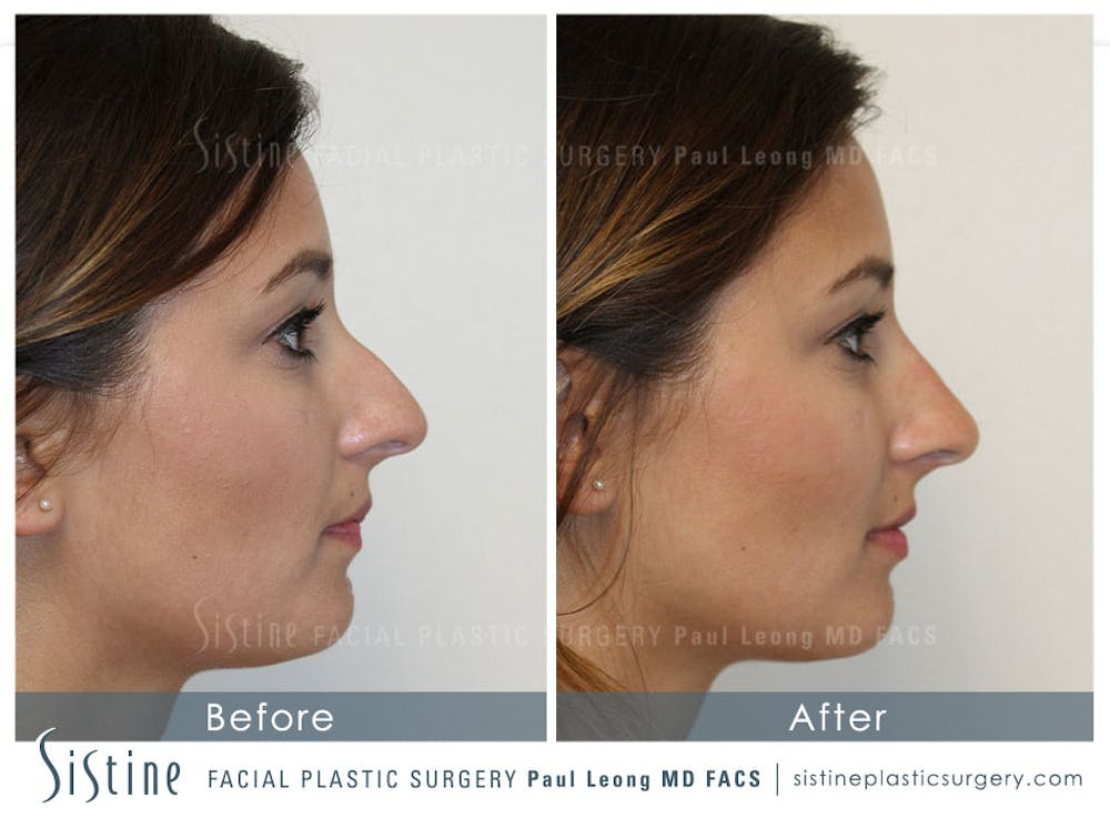 Non-Surgical Rhinoplasty Before & After Gallery - Patient 4891057 - Image 1