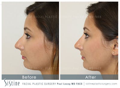 Non-Surgical Rhinoplasty Gallery - Patient 4891057 - Image 2