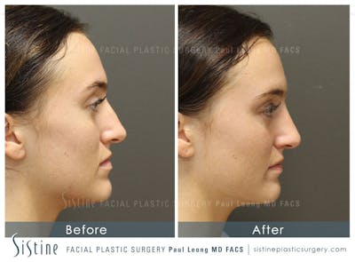Non-Surgical Rhinoplasty Before & After Gallery - Patient 4891064 - Image 1