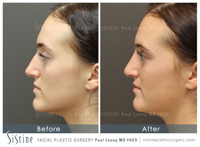 Non-Surgical Rhinoplasty Gallery - Patient 4891064 - Image 2