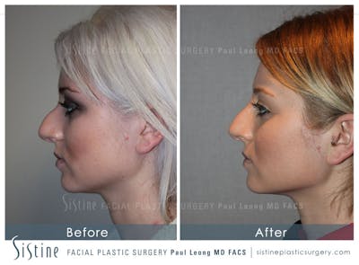Non-Surgical Rhinoplasty Before & After Gallery - Patient 4891065 - Image 1