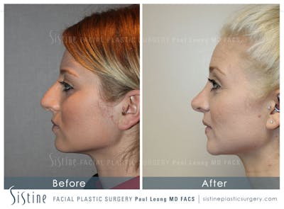 Non-Surgical Rhinoplasty Gallery - Patient 4891065 - Image 2