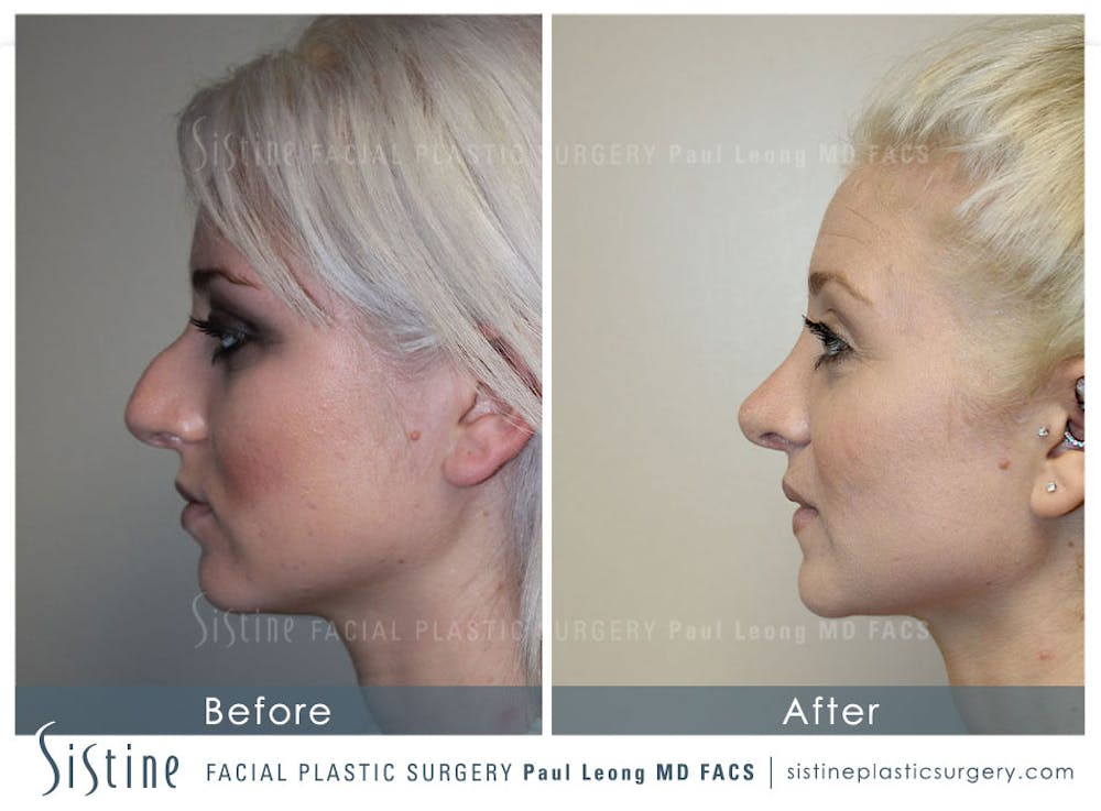 non surgical nose job before and after front view