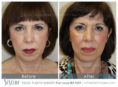 Restylane/ Juvederm Before & After Gallery - Patient 4891071 - Image 1