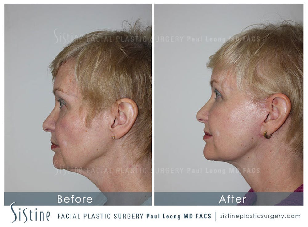 Restylane/ Juvederm Before & After Gallery - Patient 4891076 - Image 4