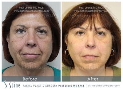 Restylane/ Juvederm Before & After Gallery - Patient 4891082 - Image 2
