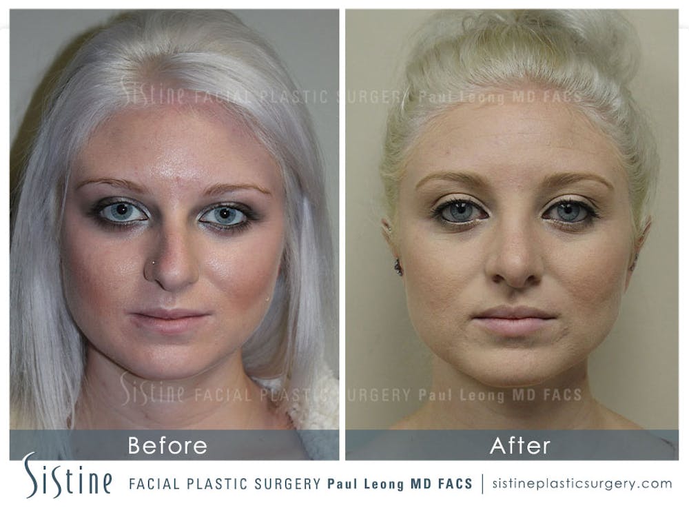 Before and After Non Surgical Rhinoplasty