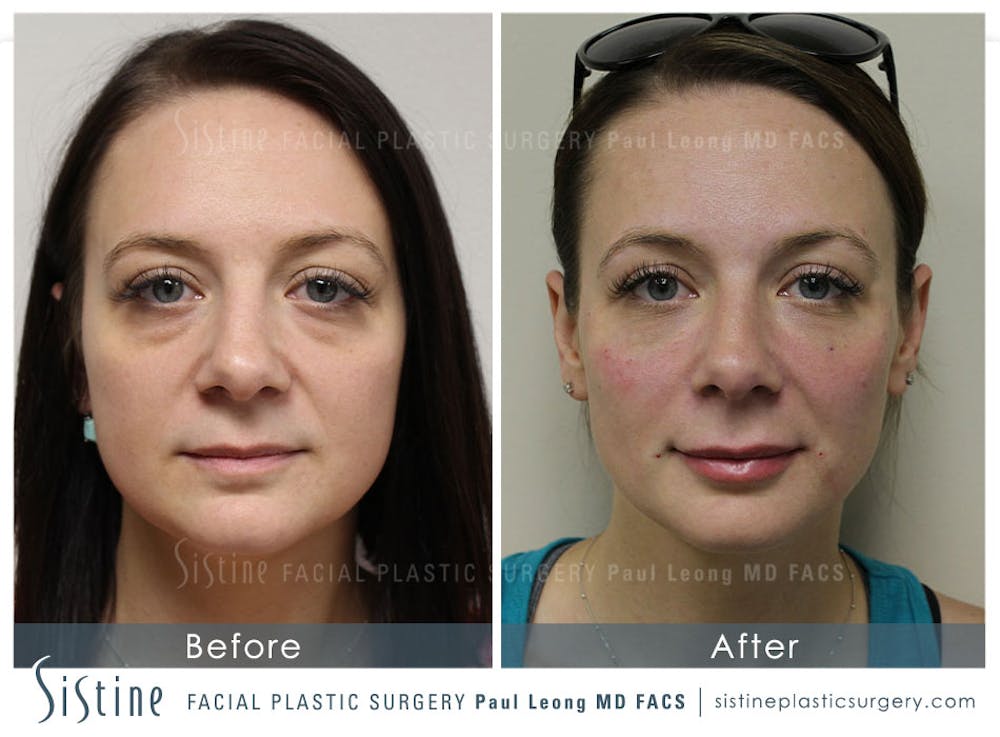 Before and After Restylane and Juvederm