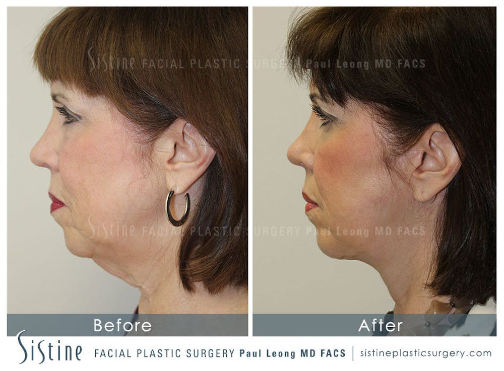 Restylane/ Juvederm Before & After Gallery - Patient 4891333 - Image 4