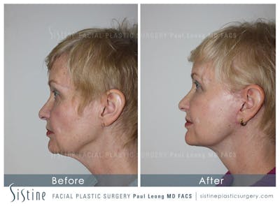 Restylane/ Juvederm Before & After Gallery - Patient 4891335 - Image 4