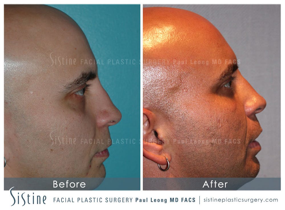 Restylane/ Juvederm Before & After Gallery - Patient 4891377 - Image 1