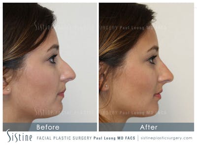 Restylane/ Juvederm Before & After Gallery - Patient 4891402 - Image 1