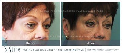 Restylane/ Juvederm Before & After Gallery - Patient 4891419 - Image 2