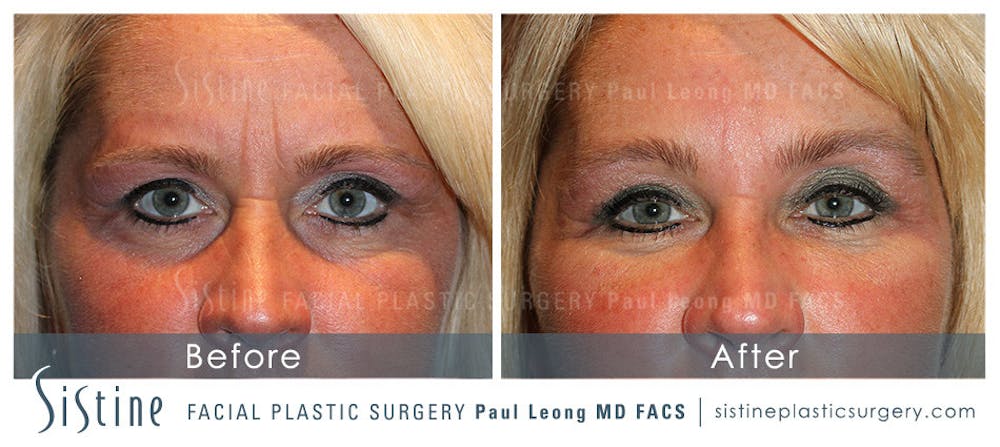 Restylane/ Juvederm Before & After Gallery - Patient 4891428 - Image 1